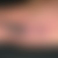 Cryoglobulinemia: Survey picture: Disseminated blue-black plaques in a reddened area caused by bl...