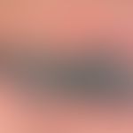 Cryoglobulinemia, detail enlargement: Area of blue-black plaque, partly covered with blackish cru...