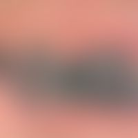 Cryoglobulinemia, detail enlargement: Area of blue-black plaque, partly covered with blackish cru...