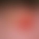Cryptococcosis of the skin: Crusty plaque of approx. 3 x 3 cm in size surroundedby a reddish, sli...