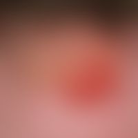 Cryptococcosis of the skin: Crusty plaque of approx. 3 x 3 cm in size surroundedby a reddish, sli...