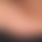 Larva migrans. general view: Acutely occurring, itchy, dynamically increasing, linear, firm, livi...