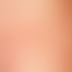 Larva migrans, detail: Garland-shaped, tortuous, erythematous, partly scaly plaque on the right f...