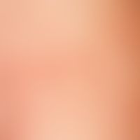 Larva migrans, detail: Garland-shaped, tortuous, erythematous, partly scaly plaque on the right f...