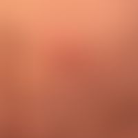 larva migrans. overview image of a duct-like linear, itchy structure. the changes have existed fo...