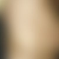 Leiomyoma (segmental cutaneous leiomyomatosis): Multiple, reddish-brownish papules in the upper a...