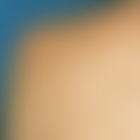 Lentigo solaris: Multiple, sharply defined light brown maculae in the area of the shoulders after...