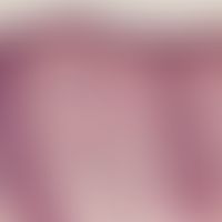 Histology: Epidermis atrophy, condensation of atypical melanocytes in the basal stratum, in place...