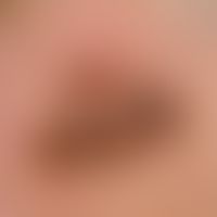 Lentigo maligna: a slow-growing, heterogeneously pigmented, light to dark brown, asymmetrical spo...