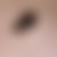 Lentigo maligna: 71-year-old patient, more than five years old, first light brown, then darkened,...