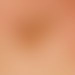 Lentigo solaris. detail enlargement: inhomogeneously coloured, light brown, sharply defined spot.