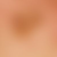 Lentigo solaris. detail enlargement: inhomogeneously coloured, light brown, sharply defined spot.