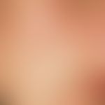 Lentigo solaris (solar lentigo): Light brown, sharply defined spot in the area of chronically UV-...