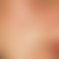 Lentigo solaris (solar lentigo). Hellbrauner, scharf begrenzter Fleck im Bereich der chronisch UV...