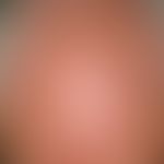 Lentigo solaris: multiple, disseminated, a few millimetres to 1.5 centimetres in size, oval, roun...