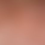 Lentigo solaris. detail enlargement: multiple, disseminated, a few millimetres up to 1.5 centimet...