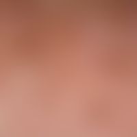 Lentigo solaris. detail enlargement: multiple, disseminated, a few millimetres up to 1.5 centimet...