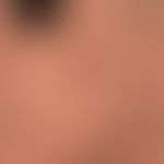 Lentigo solaris (solar lentigo): a slow-growing, symptom-free, brown spot, which has been present...