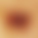 Lentigo simplex. reflected light microscopy (female, 51 years; middle of back): Regular, highly p...