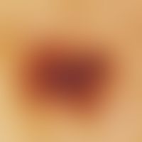 Lentigo simplex. reflected light microscopy (female, 51 years; middle of back): Regular, highly p...