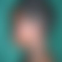 Leprareaktion vom Typ I "upgrading reaction": bei einer Patientin mit Boderline lepromatöser Lepr...