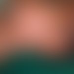 Lepra. Lepra lepromatosa (-LL-)&nbsp;mit großflächigem, diskreten etwas randbetonter Plaque an Wa...