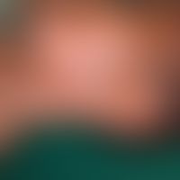 Leprosy. leprosy lepromatosa (-LL-) with large, discreet, somewhat borderline plaque on the cheek...