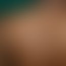 Lepra indeterminata (-I-). Großflächige hypopigmentierte, nur gering hypästhetische, wenig infilt...