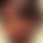 Leprosy lepromatosa, facial infestation in a 12-year-old Indian boy with extensive erythema and m...