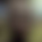 Leprosy lepromatosa: most severe course of leprosy leprormatosa with multiple, partly confluent, ...