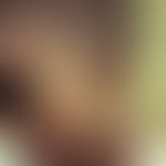 Leprosy tuberculoides (-TT-). marginal, somewhat hypopigmented and hypaesthetic plaques in the fa...