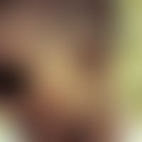 Leprosy tuberculoides (-TT-). marginal, somewhat hypopigmented and hypaesthetic plaques in the fa...