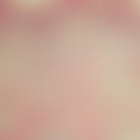 Leprosy tuberculoides; granulomatous penetration of the corium; HE staining.
