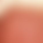 Leukokeratosis nicotinica palati. Teils flächige, teils warzige Leukoplakien am harten Gaumen.