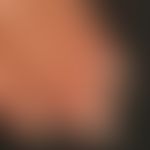 Leuconychia striata: Übersichtsaufnahme: Weißliche Querstreifen in den Nagelplatten bei einer 48-...