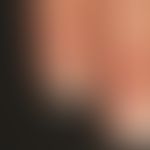 Leuconychia striata: Detailausschnitt: Die 48-jährige Patientin berichtete über eine farbliche Ve...