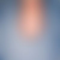 Leuconychia striata longitudinalis. Weißer Längsstreifen am Fingernagel bei einem 45-jährigen Man...