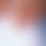 Leukonychie: In Querstreifen verlaufende Weißfärbungen der Nagelplatte bei einer 20-jährigen Frau...