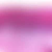 Leukoplakie, orale. Benigne orale Leukoplakie mit breiter unregelmäßiger Akanthose; kräftig entwi...