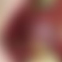 Leukoplakie, orale:&nbsp;55 Jahre alter Zigarettenraucher. Chronisch stationäre, einseitige, fläc...