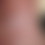 Leukoplakie, orale: &nbsp;chronisch stationäre (Dauer unklar), 1,5 x 3,0 cm große, schmerzlose, g...