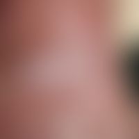 Leukoplakie, orale: &nbsp;chronisch stationäre (Dauer unklar), 1,5 x 3,0 cm große, schmerzlose, g...