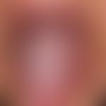 Leukoplakie, orale.&nbsp;Pflastersteinartig gefelderte Zungenoberfläche mit tiefer Querfurchung.
