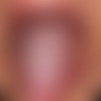 Leukoplakie, orale.&nbsp;Pflastersteinartig gefelderte Zungenoberfläche mit tiefer Querfurchung.
