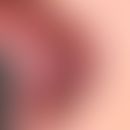 Leukoplakie orale: flächige Leukoplakie im Wangenbereich bei starkem Raucher. Histologisch: Präka...