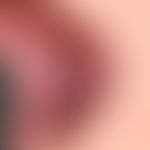 Leukoplakie orale: flächige Leukoplakie im Wangenbereich bei starkem Raucher. Histologisch: Präka...