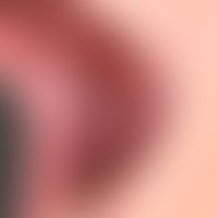 Leukoplakie orale: flächige Leukoplakie im Wangenbereich bei starkem Raucher. Histologisch: Präka...