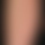 Lichen amyloidosus: General view: Since several years slowly progressive findings with densely pa...