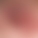 Lichen aureus: therapy-refractory variant of Purpura pigmentosa progressiva. lichenoid plaques. n...