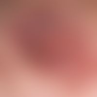 Lichen aureus: therapy-refractory variant of Purpura pigmentosa progressiva. lichenoid plaques. n...